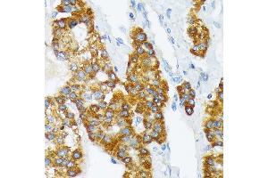 Immunohistochemistry of paraffin-embedded human liver cancer using B3 Rabbit mAb (ABIN7265774) at dilution of 1:100 (40x lens). (ATP1B3 anticorps)