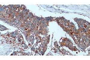 Detection of CTSD in Human Liver cancer Tissue using Monoclonal Antibody to Cathepsin D (CTSD) (Cathepsin D anticorps  (AA 21-412))