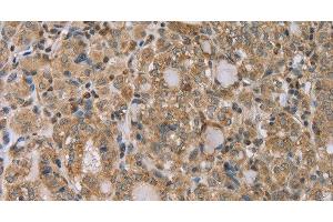 Immunohistochemistry of paraffin-embedded Human thyroid cancer tissue using RAB39B Polyclonal Antibody at dilution 1:45 (RAB39B anticorps)