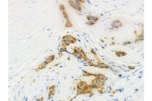 ABIN6262841 and ABIN6274094 at 1/100 staining human pancreatic carcinoma by IHC-P.