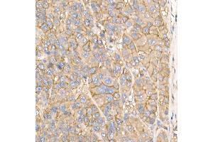 Immunohistochemistry of paraffin-embedded human liver cancer using Na+/K+-ATPase Rabbit pAb (ABIN6133568, ABIN6137299, ABIN6137301 and ABIN6223860) at dilution of 1:50 (40x lens).