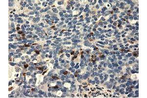 Immunohistochemical staining of paraffin-embedded Adenocarcinoma of Human ovary tissue using anti-MICAL1 mouse monoclonal antibody. (MICAL1 anticorps)