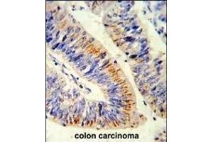 Formalin-fixed and paraffin-embedded human colon carcinoma reacted with RELA Antibody (N-term), which was peroxidase-conjugated to the secondary antibody, followed by DAB staining.