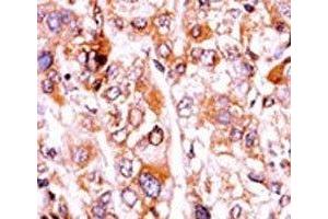 IHC analysis of FFPE human hepatocarcinoma tissue stained with the phosphorylated-p21 antibody.