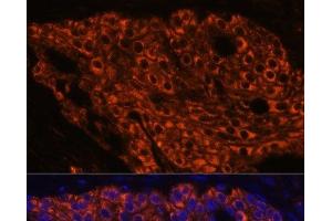 Immunofluorescence analysis of Human lung cancer using SFTPC Polyclonal Antibody at dilution of 1:100 (40x lens).