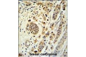 FBXL15 Antibody (C-term) (ABIN651414 and ABIN2840224) immunohistochemistry analysis in formalin fixed and paraffin embedded human breast carcinoma followed by peroxidase conjugation of the secondary antibody and DAB staining.