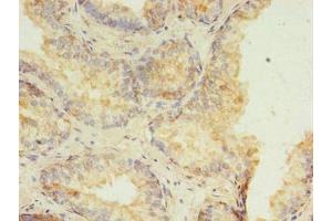 Immunohistochemistry of paraffin-embedded human prostate cancer using ABIN7155196 at dilution of 1:100 (HMGN3 anticorps  (AA 1-77))