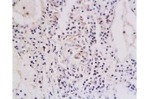 Formalin-fixed and paraffin embedded human oral squamous cell carcinoma labeled with Anti-TNFRSF18 Polyclonal Antibody , Unconjugated at 1:200, followed by conjugation to the secondary antibody and DAB staining (TNFRSF18 anticorps  (AA 201-274))