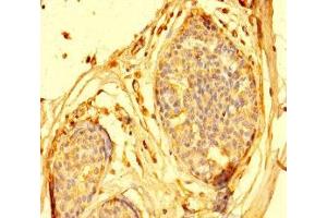 Immunohistochemistry of paraffin-embedded human breast cancer using ABIN7144032 at dilution of 1:100 (AMIGO1 anticorps  (AA 28-327))