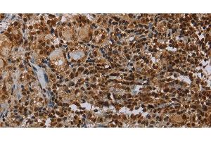 Immunohistochemistry of paraffin-embedded Human thyroid cancer using TBX5 Polyclonal Antibody at dilution of 1:35 (T-Box 5 anticorps)