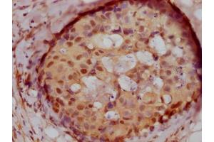 IHC image of ABIN7127675 diluted at 1:100 and staining in paraffin-embedded human breast cancer performed on a Leica BondTM system.