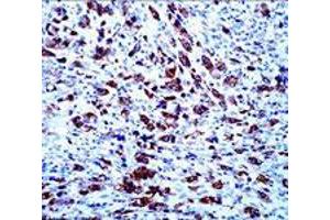 Immunohistochemical staining of APOA5 on paraffin-embedded human anaplastic lymphoma with APOA5 monoclonal antibody, clone 1G5G9 . (APOA5 anticorps)