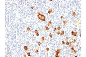 Formalin-fixed, paraffin-embedded human Hodgkin's Lymphoma stained with CD15 Mouse Monoclonal Antibody (FUT4/815). (CD15 anticorps)