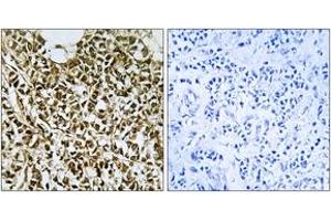 Immunohistochemistry analysis of paraffin-embedded human breast carcinoma tissue, using RPC5 Antibody. (POLR3E anticorps  (AA 191-240))