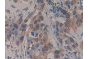 Detection of BCAS3 in Human Breast cancer Tissue using Polyclonal Antibody to Breast Carcinoma Amplified Sequence 3 (BCAS3)