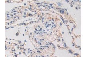 Detection of POSTN in Human Lung cancer Tissue using Polyclonal Antibody to Periostin (POSTN)