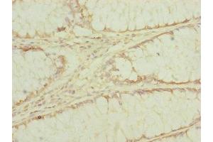 Immunohistochemistry of paraffin-embedded human colon cancer using ABIN7151546 at dilution of 1:100