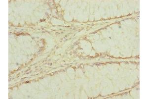 Immunohistochemistry of paraffin-embedded human colon cancer using ABIN7151546 at dilution of 1:100 (EEF1G anticorps  (AA 168-437))