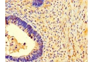 Immunohistochemistry of paraffin-embedded human ovarian cancer using ABIN7142435 at dilution of 1:100 (MRPL39 anticorps  (AA 1-158))