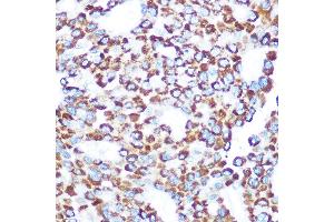 Immunohistochemistry of paraffin-embedded human liver cancer using T Rabbit pAb (ABIN7270794) at dilution of 1:100 (40x lens).