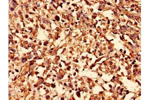 Immunohistochemistry analysis of human melanoma using ABIN7170123 at dilution of 1:100