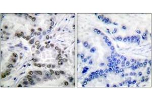 Immunohistochemistry analysis of paraffin-embedded human lung carcinoma tissue, using CBP (Acetyl-Lys1535) Antibody. (CBP anticorps  (acLys1535))
