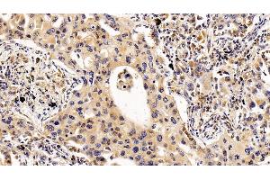 Detection of IL2Ra in Human Lung cancer Tissue using Polyclonal Antibody to Interleukin 2 Receptor Alpha (IL2Ra)