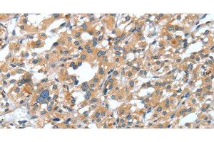 Immunohistochemistry of paraffin-embedded Human thyroid cancer tissue using DSC1 Polyclonal Antibody at dilution 1:40