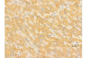 ABIN6257703 and ABIN6273923 at 1/100 staining human hepatocellular carcinoma by IHC-P. (CCKBR anticorps  (N-Term))