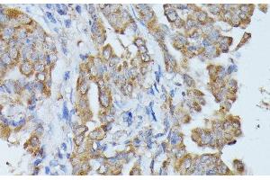 Immunohistochemistry of paraffin-embedded Human thyroid cancer using HAL Polyclonal Antibody at dilution of 1:100 (40x lens).