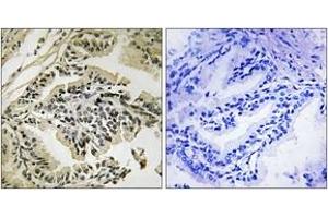 Immunohistochemistry analysis of paraffin-embedded human prostate carcinoma, using PEK/PERK (Phospho-Thr981) Antibody.