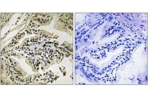 Immunohistochemistry analysis of paraffin-embedded human prostate carcinoma, using PEK/PERK (Phospho-Thr981) Antibody. (PERK anticorps  (pThr981))