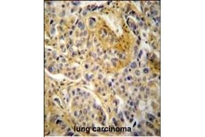 NCF1 Antibody (N-term) (ABIN652063 and ABIN2840531) immunohistochemistry analysis in formalin fixed and paraffin embedded human lung carcinoma followed by peroxidase conjugation of the secondary antibody and DAB staining.