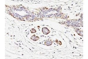 Formalin-fixed, paraffin-embedded human breast carcinoma stained with SMMHC antibody (MYH11/923). (MYH11 anticorps)