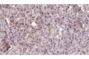 ABIN6273230 at 1/100 staining Human pancreas cancer tissue by IHC-P. (DDC anticorps  (Internal Region))