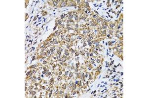 Immunohistochemistry of paraffin-embedded human lung cancer using TP53 antibody.