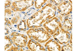 ABIN6257428 and ABIN6275868 at 1/100 staining Human kidney cancer and adjacent normal tissues by IHC-P. (CD90 anticorps  (Internal Region))