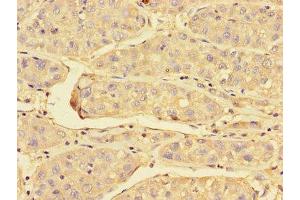 Immunohistochemistry of paraffin-embedded human liver cancer using ABIN7172023 at dilution of 1:100