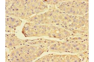 Immunohistochemistry of paraffin-embedded human liver cancer using ABIN7172023 at dilution of 1:100 (Peroxiredoxin 3 anticorps  (AA 63-256))