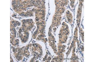 Immunohistochemistry of Human gastric cancer using DSG2 Polyclonal Antibody at dilution of 1:50 (Desmoglein 2 anticorps)
