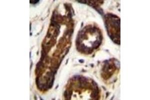 Immunohistochemistry analysis in formalin fixed and paraffin embedded human breast tissue reacted with SERPINB5 / Maspin Antibody (Center) followed which was peroxidase conjugated to the secondary antibody and  followed by DAB staining.