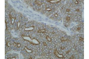 Detection of cytokeratin on paraffin-embedded sections of guinea pig breast carcinoma using anti-cytokeratin antibody