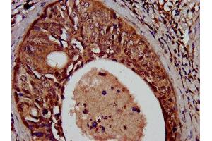 IHC image of ABIN7169920 diluted at 1:500 and staining in paraffin-embedded human cervical cancer performed on a Leica BondTM system.