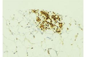 ABIN6273834 at 1/100 staining Human breast cancer tissue by IHC-P. (Kallikrein 6 anticorps  (C-Term))