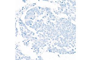 Immunohistochemistry of paraffin-embedded Human lung squamous carcinoma tissue(negative control samples) using TTF1 antibody (ABIN1679475, ABIN3017648, ABIN3017649 and ABIN7101514) at dilution of 1:1000 (40x lens).