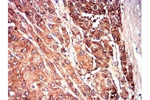 Immunohistochemical analysis of paraffin-embedded liver cancer tissues using SAA1 mouse mAb with DAB staining. (SAA1 anticorps  (AA 19-212))