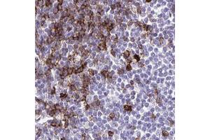Immunohistochemical staining (Formalin-fixed paraffin-embedded sections) of human lymphoma with SPN polyclonal antibody  shows strong cytoplasmic positivity in a subset of tumor cells. (CD43 anticorps  (AA 315-394))