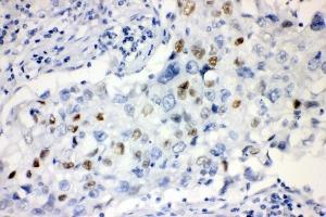 IHC analysis of CCNE1 using anti-CCNE1 antibody (ABIN7601193). (Cyclin E1 anticorps  (AA 3-386))