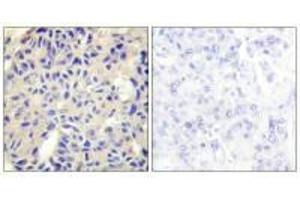 Immunohistochemistry analysis of paraffin-embedded human breast carcinoma tissue using Collagen V α2 antibody. (COL5A2 anticorps)