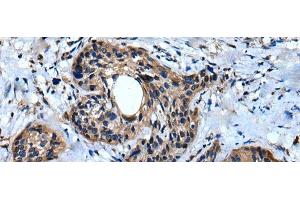 Immunohistochemistry of paraffin-embedded Human cervical cancer tissue using IQGAP1 Polyclonal Antibody at dilution of 1:30(x200) (IQGAP1 anticorps)